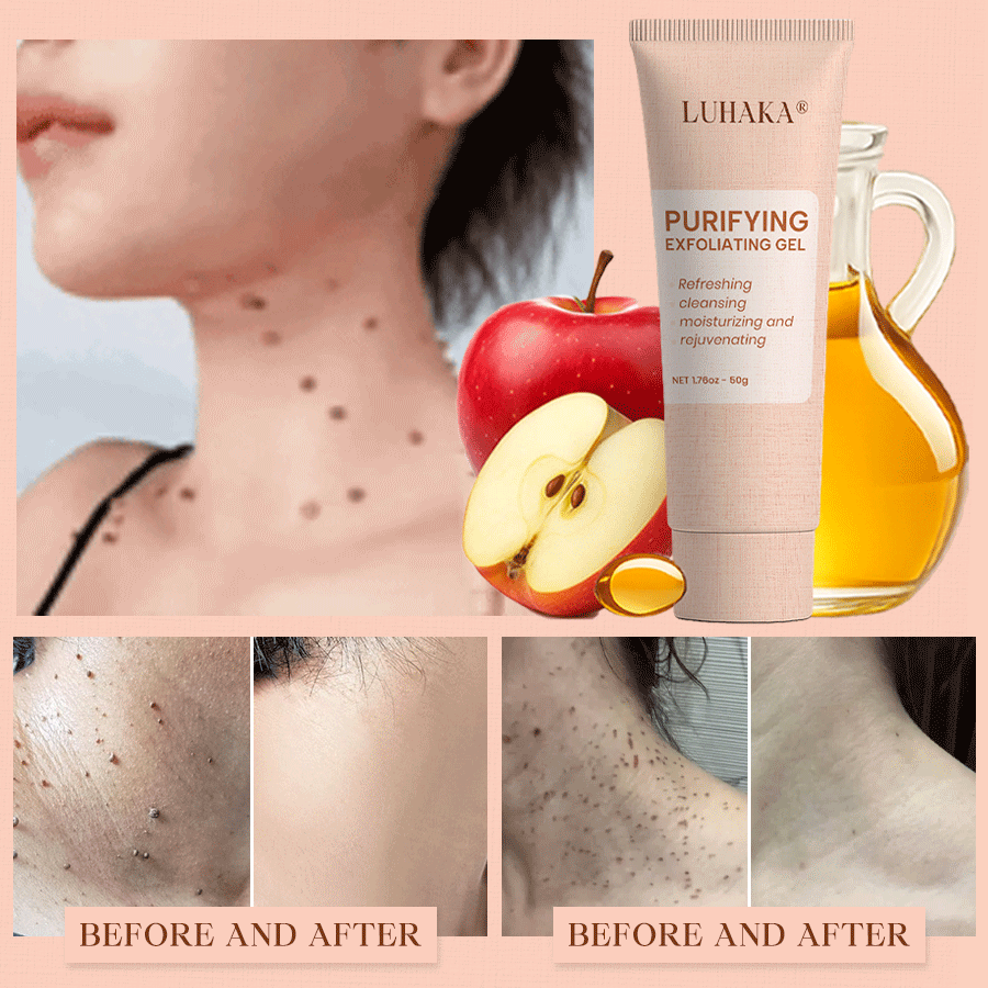 Luhaka® Purifying Exfoliating Gel for Acanthosis Nigricans, Exfoliation, Dark Spots, Skin Tags, and Eczema